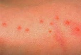 example of bed bug bites