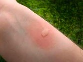 example of mosquito bite
